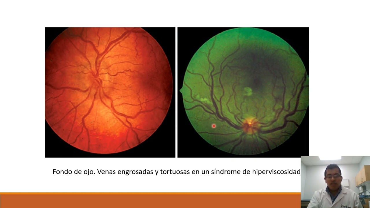 MACROGLOBULINEMIA DE WALDESTROM