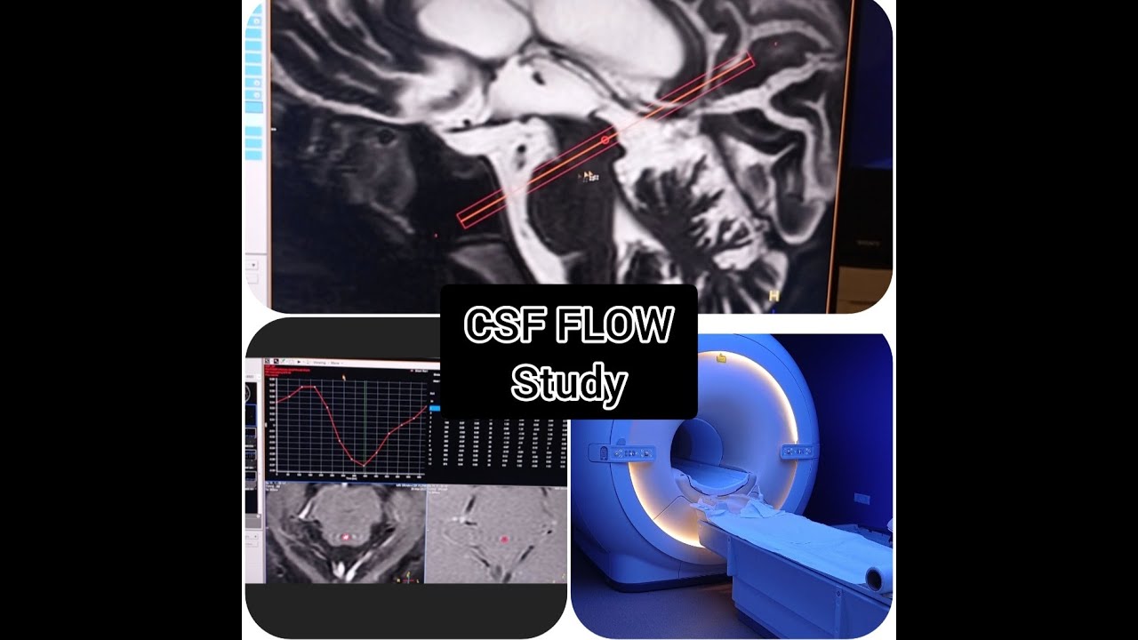 MRI CSF FLOW STUDY II PHILIPS 3T