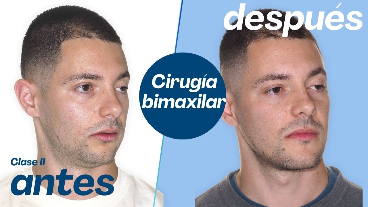 Cirug&iacute;a Bimaxilar Caso #165 | Clase II, Retrusi&oacute;n Maxilo-Mandibular y Mordida Abierta &ndash; Pablo