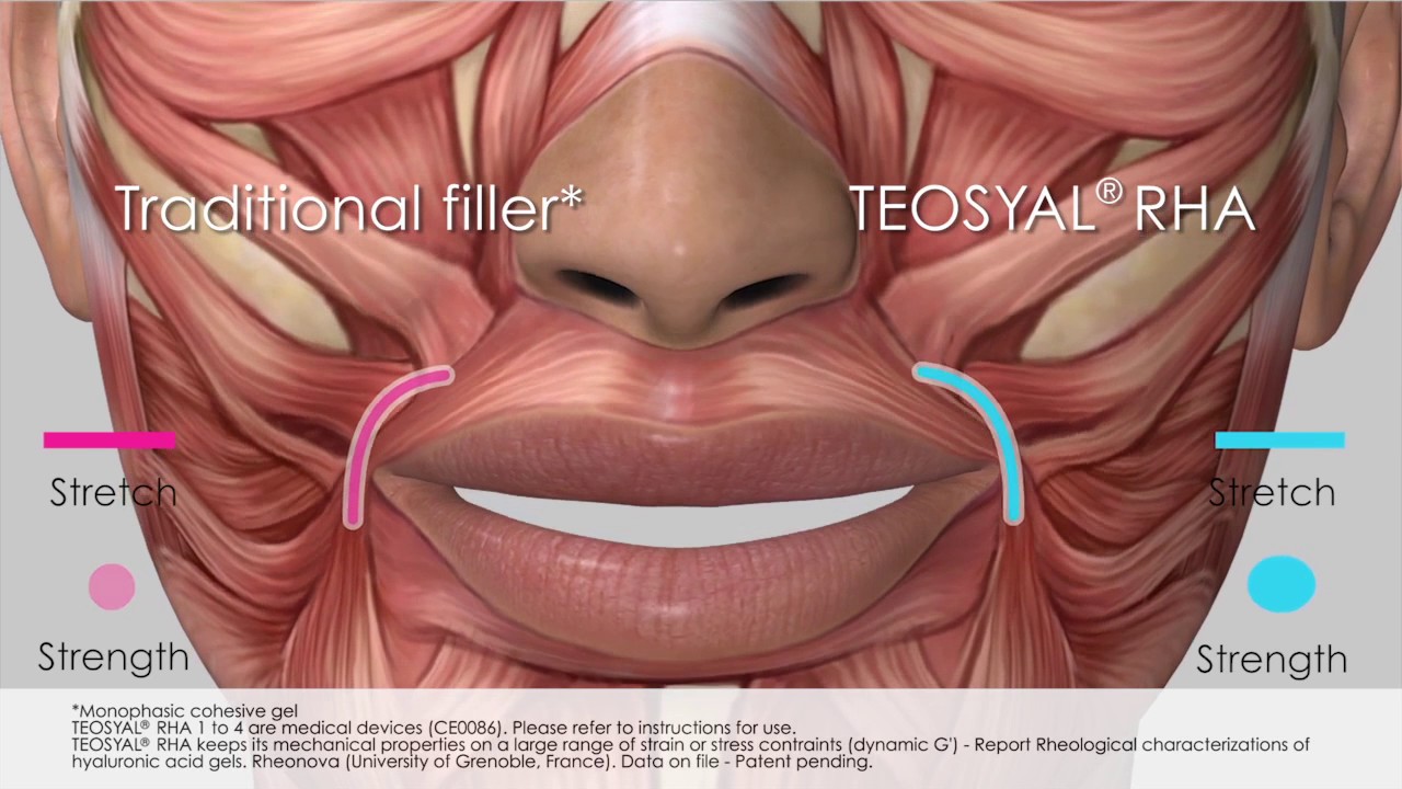 Traditional Filler VS TEOXANE RHA | The Era of Dynamic Aesthetics