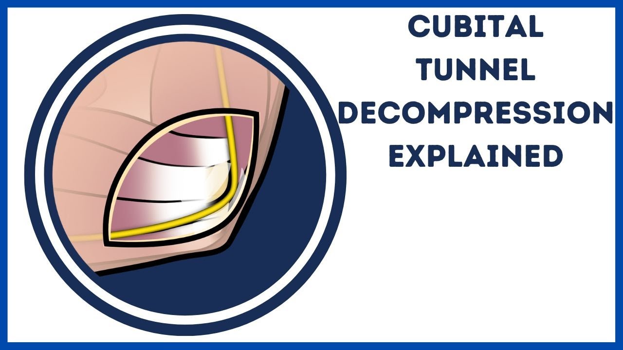 Cubital Tunel Decompression / Ulnar Nerve Release Explained