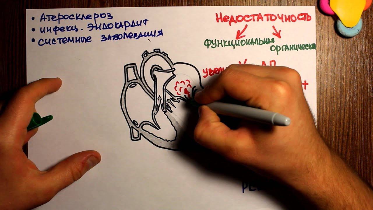 Митральная недостаточность - 