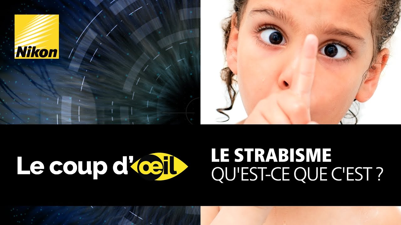 Le strabisme, qu'est-ce que c'est ?