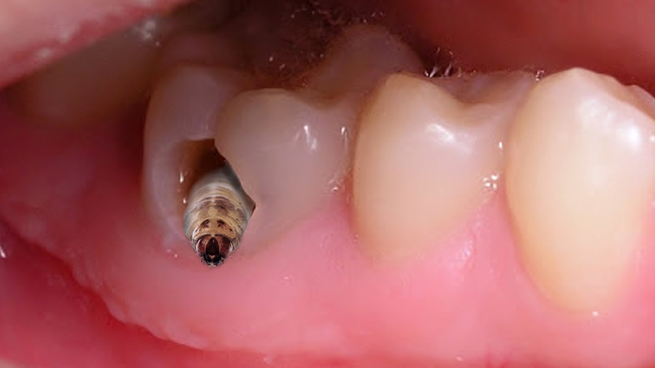 Trám răng sâu xoang 5 (fillings caries)