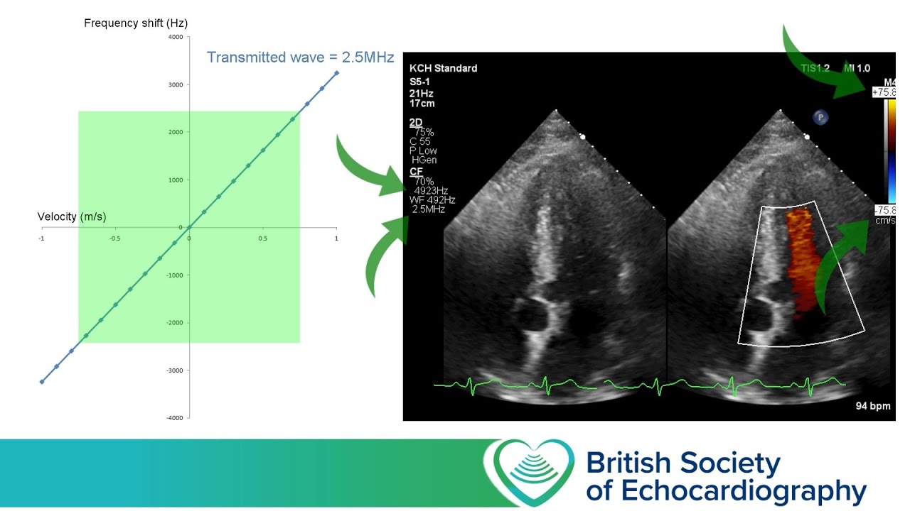 Level 1 - Colour Doppler