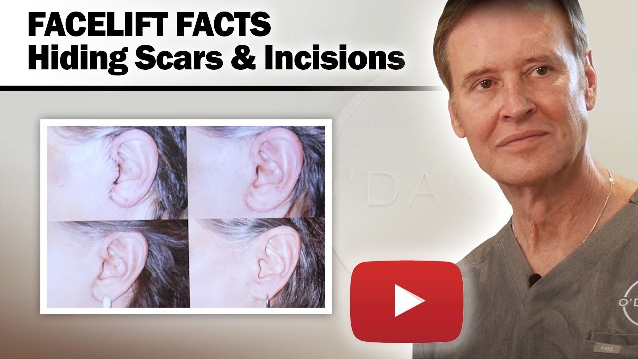 FACELIFT FACTS - Hiding Scars And Incisions - Dr. O'Daniel