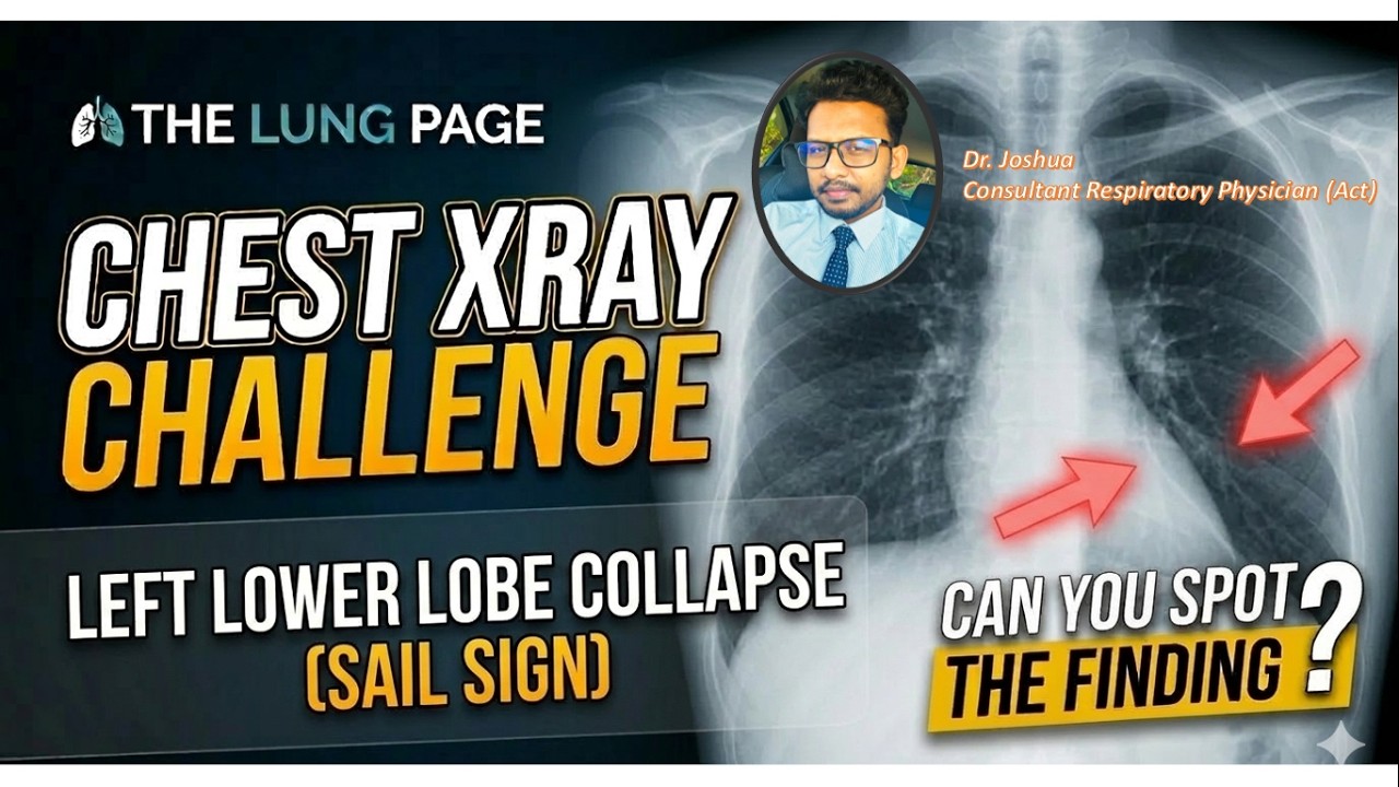 Chest X-ray Challenge - 10 - Left Lower Lobe Collapse - Sail Sign