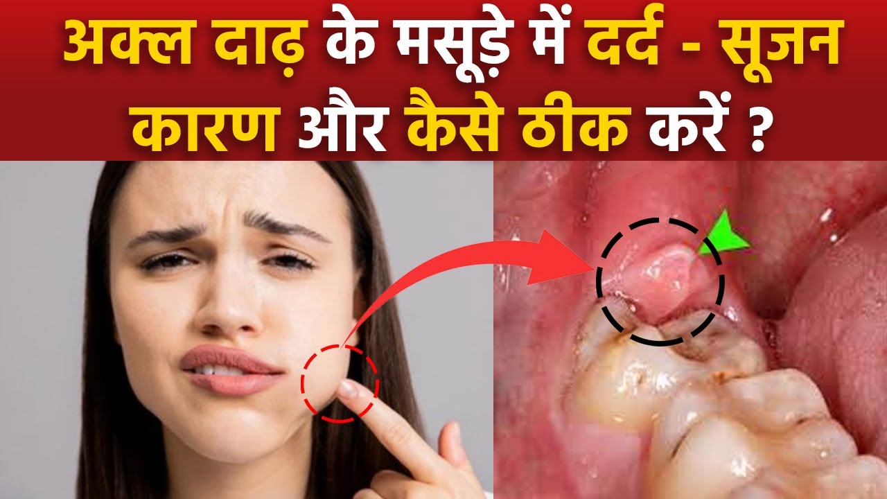 Pericoronitis Treatment At Home: Akal Daad Ke Masude Fulne Ka Ilaj |Wisdom Teeth Gum Swelling Remedy