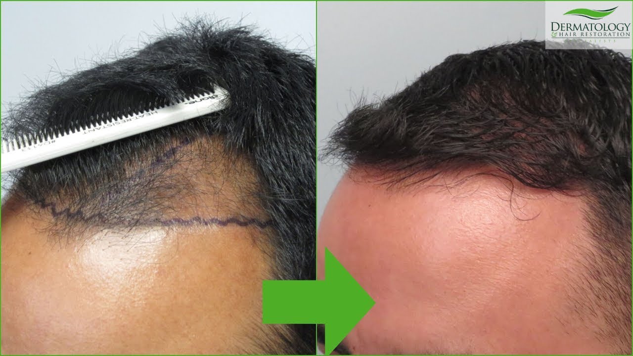 FUE Hair Transplant Update INCREDIBLE Results - Before and After - Los Angeles