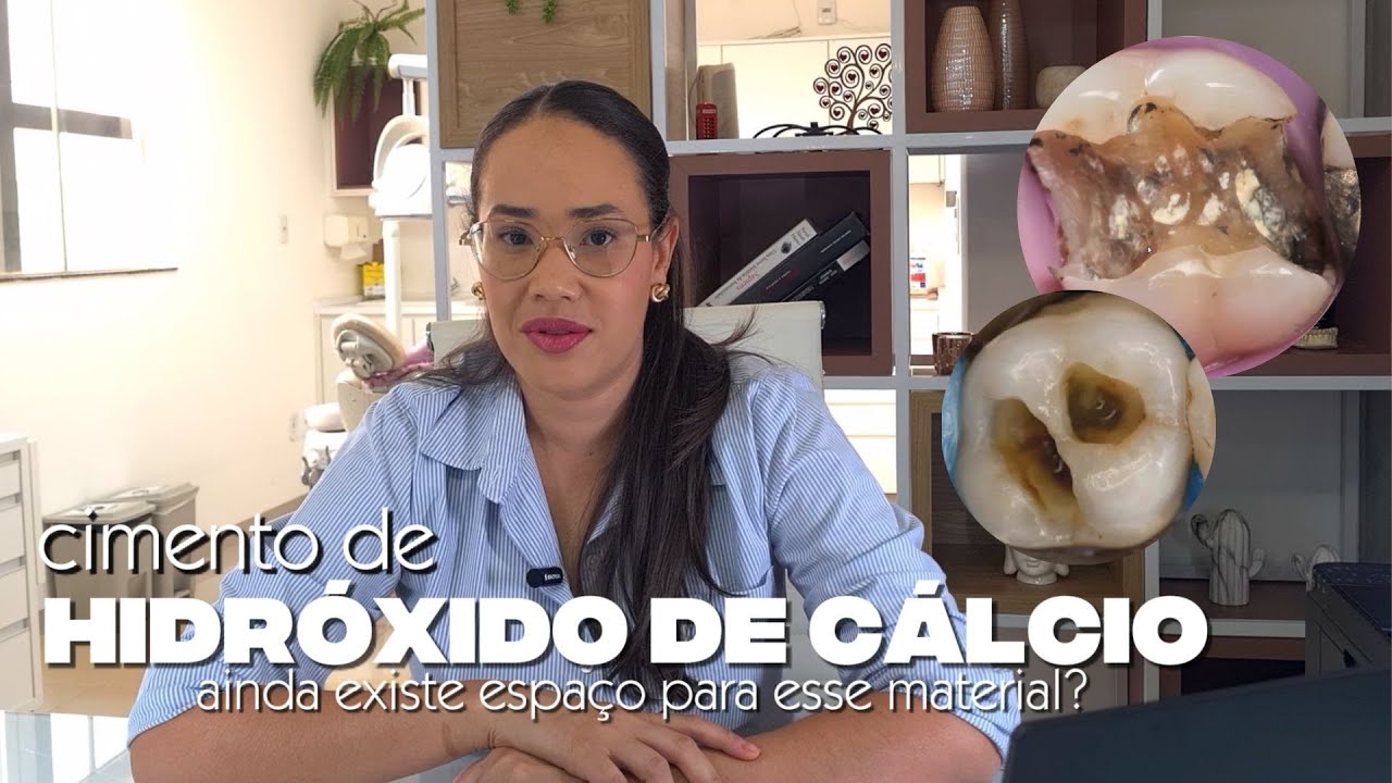 CIMENTO DE HIDRÓXIDO DE CÁLCIO: Ainda Existe Espaço Para Esse Material? | Dentística Descomplicada