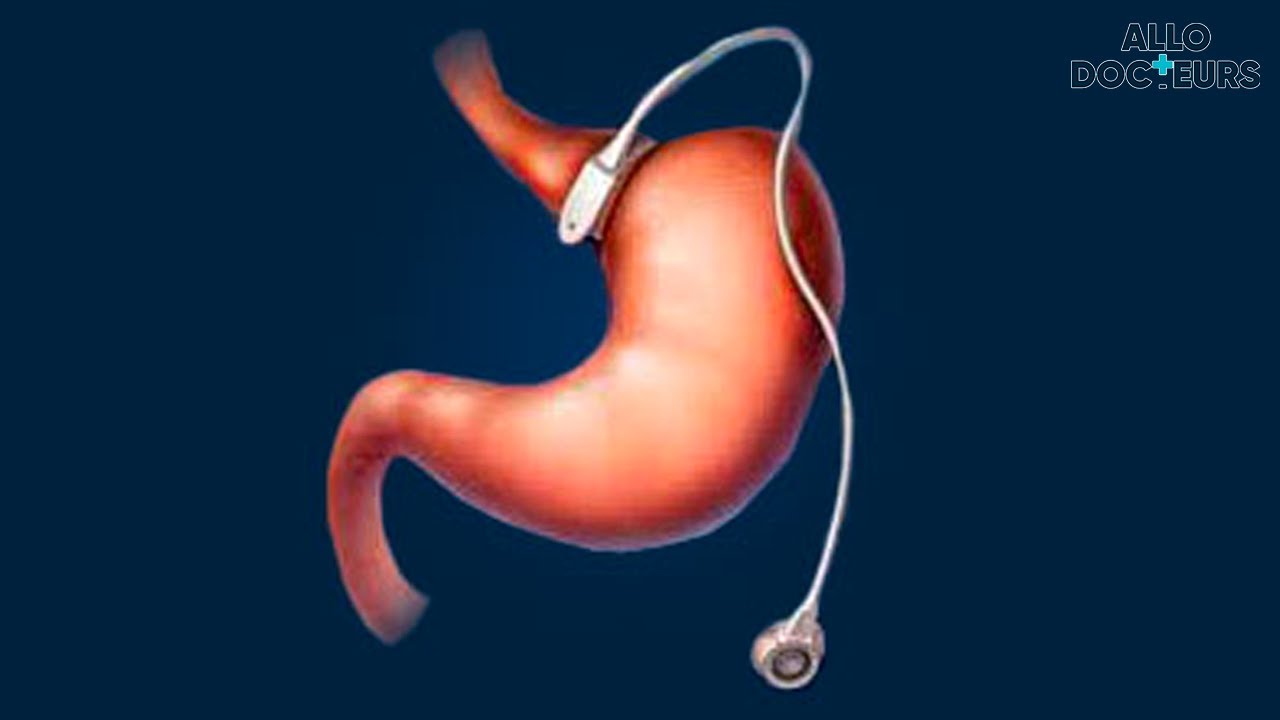 Tout savoir sur la pose d'un anneau gastrique