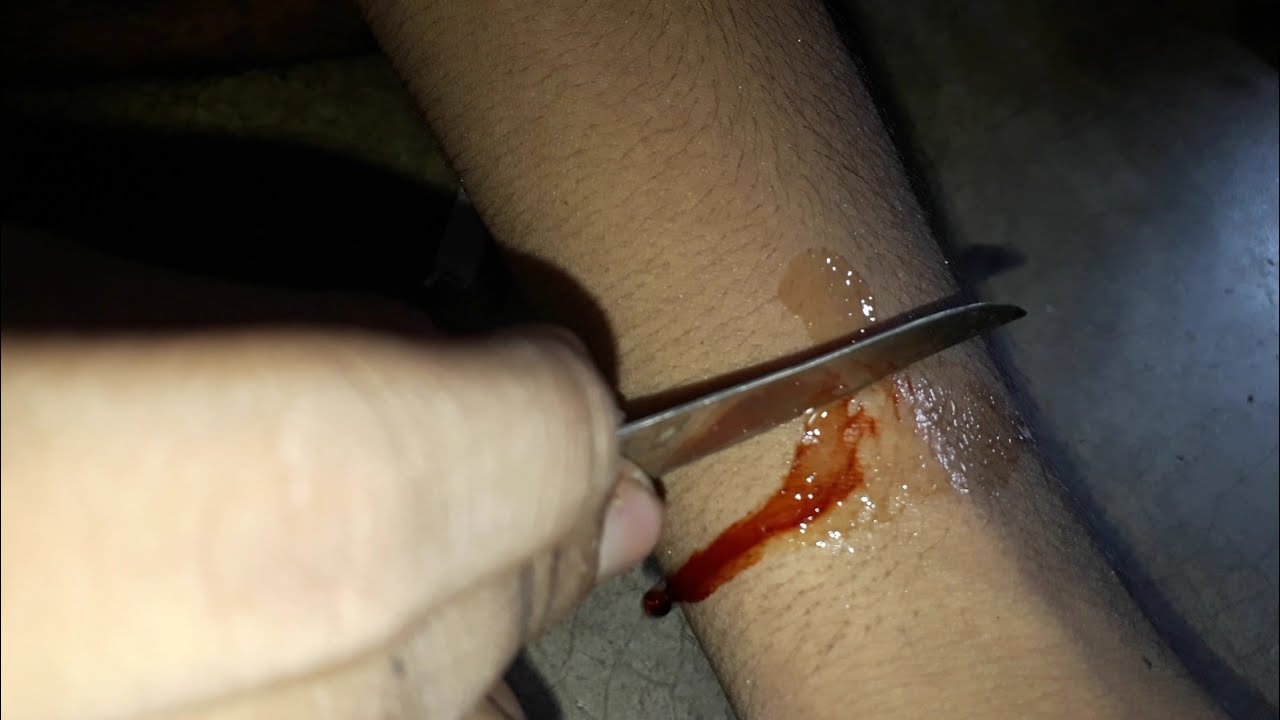 Bl**d from my hand using chemistry