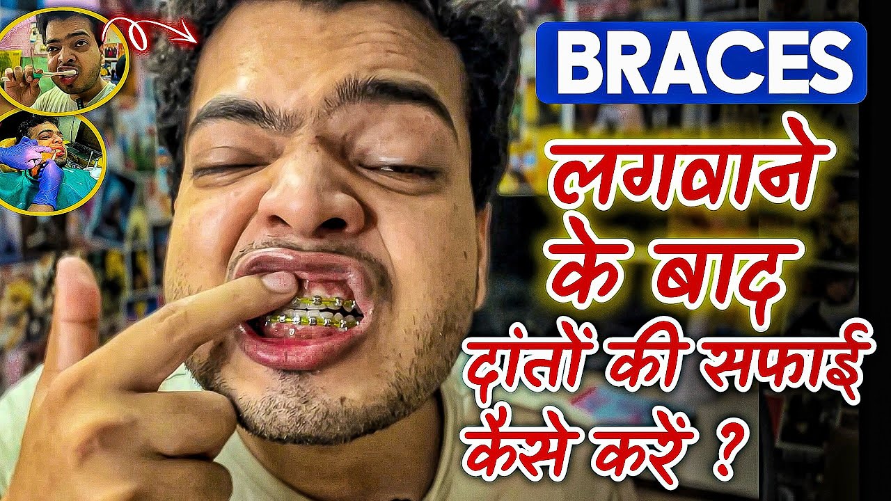 Braces लगवाने के बाद दाँत कैसे साफ करें | How To Clean Your Teeth After Getting Braces | #braces 