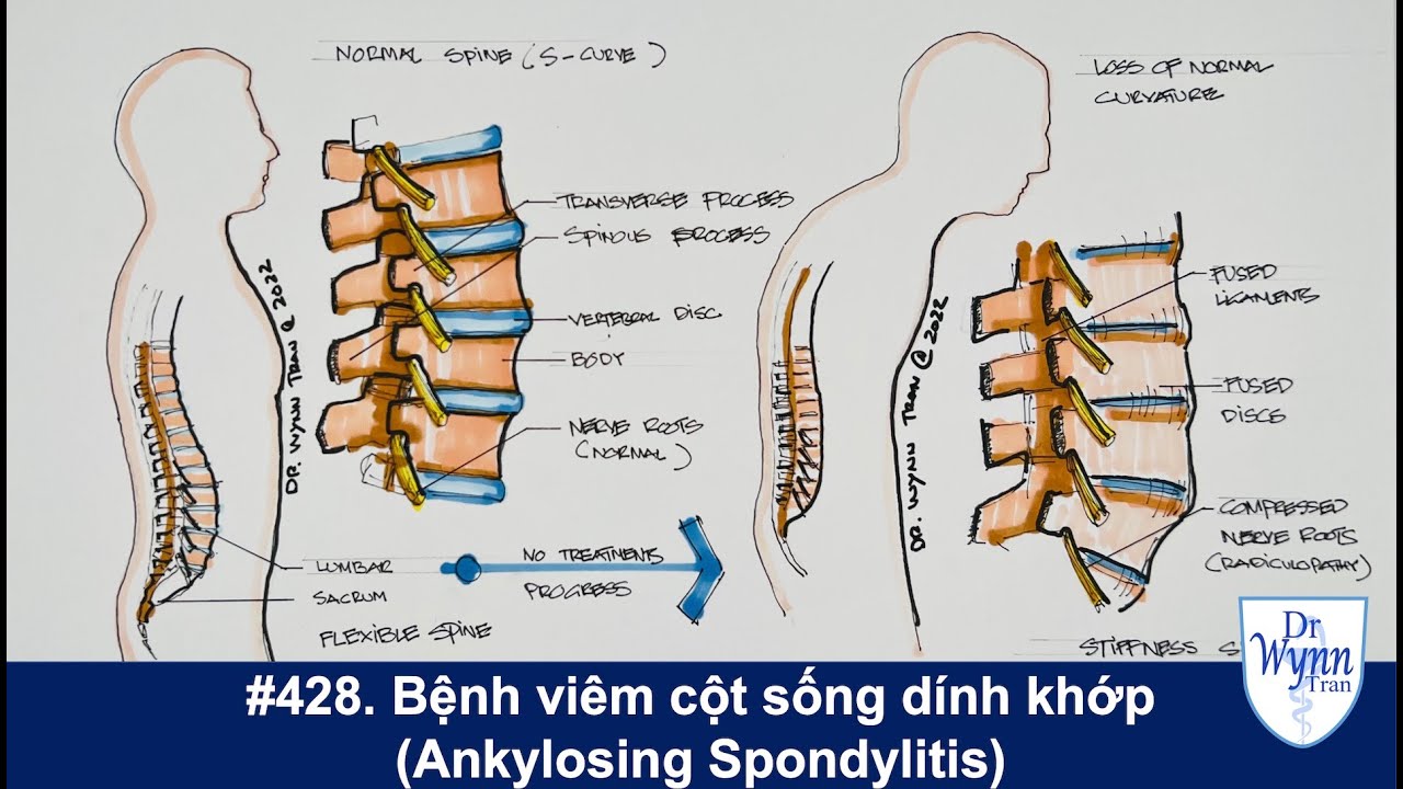 #428. Đau lưng ở người trẻ: Bệnh viêm cột sống dính khớp (Ankylosing spondylitis)