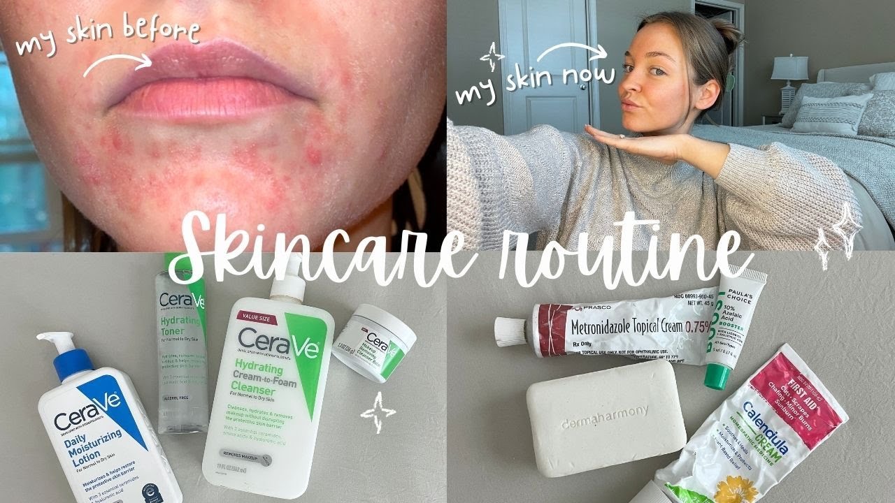 Skincare Routine| How I cleared my perioral dermatitis & BEST skincare products for sensitive skin