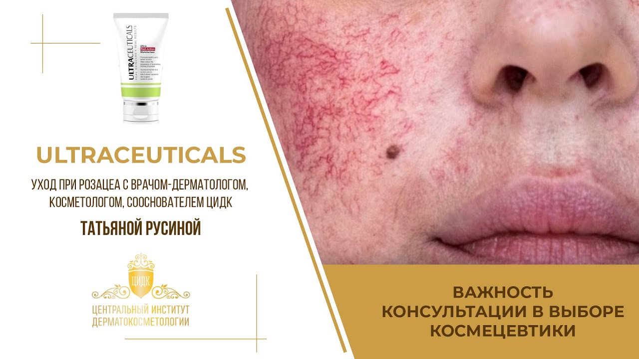 Важность консультации в выборе космецевтики. Уход Ultraceuticals при Розацеа.