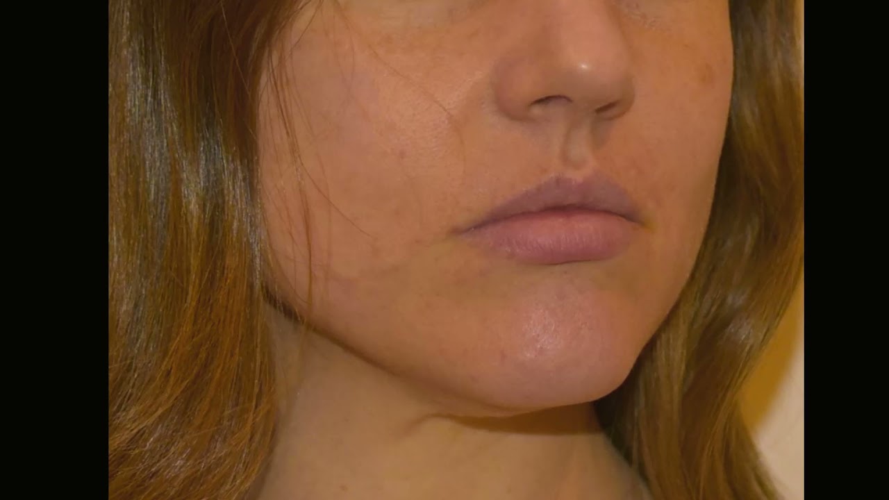 The lower face evolution