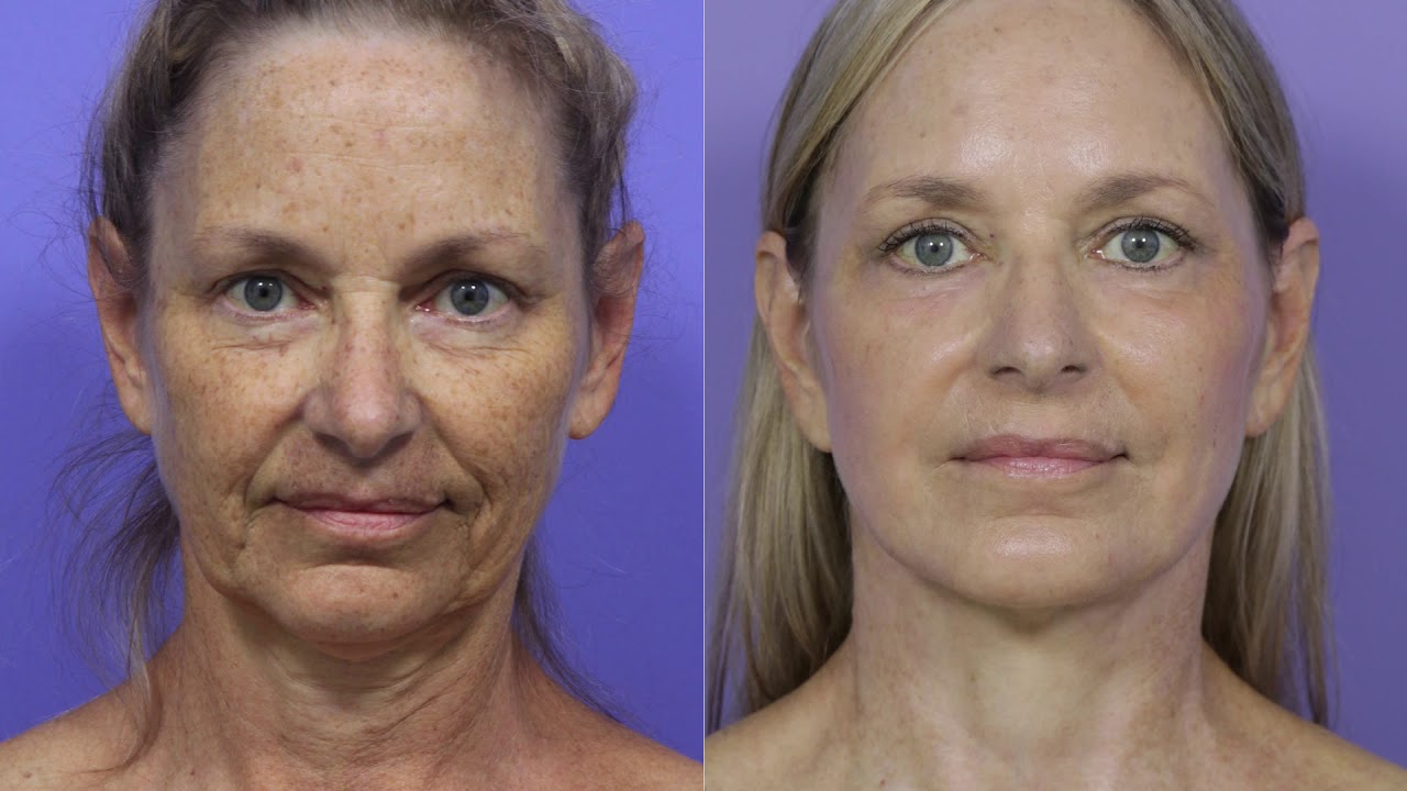 Facelift at Stoker Plastic Surgery | Los Angeles