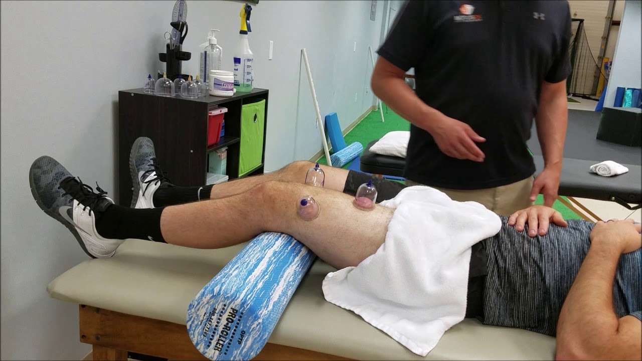 Cupping Variations of the Quadriceps