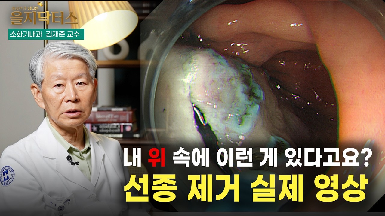 Something like this inside my stomach? Real footage of a gastric adenoma removal!