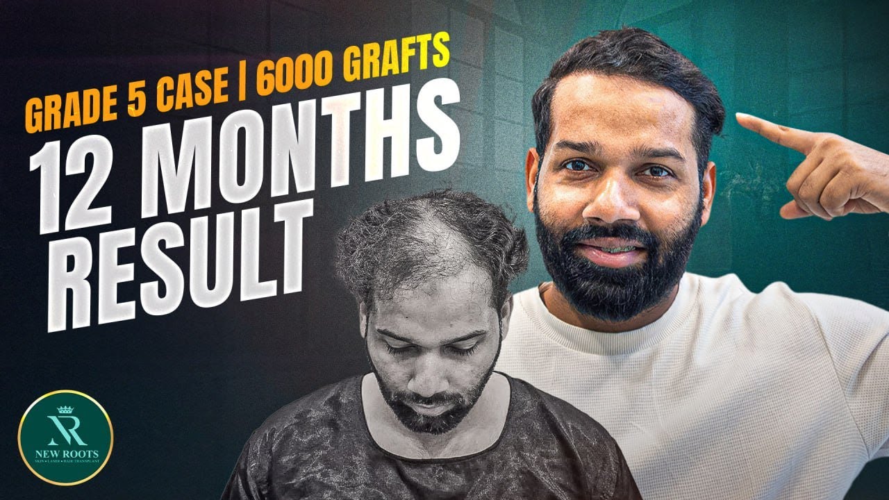 12 Months After Hair Transplant 😃 | Hair Transplant in Nagpur | Cost & Best Results | New Roots