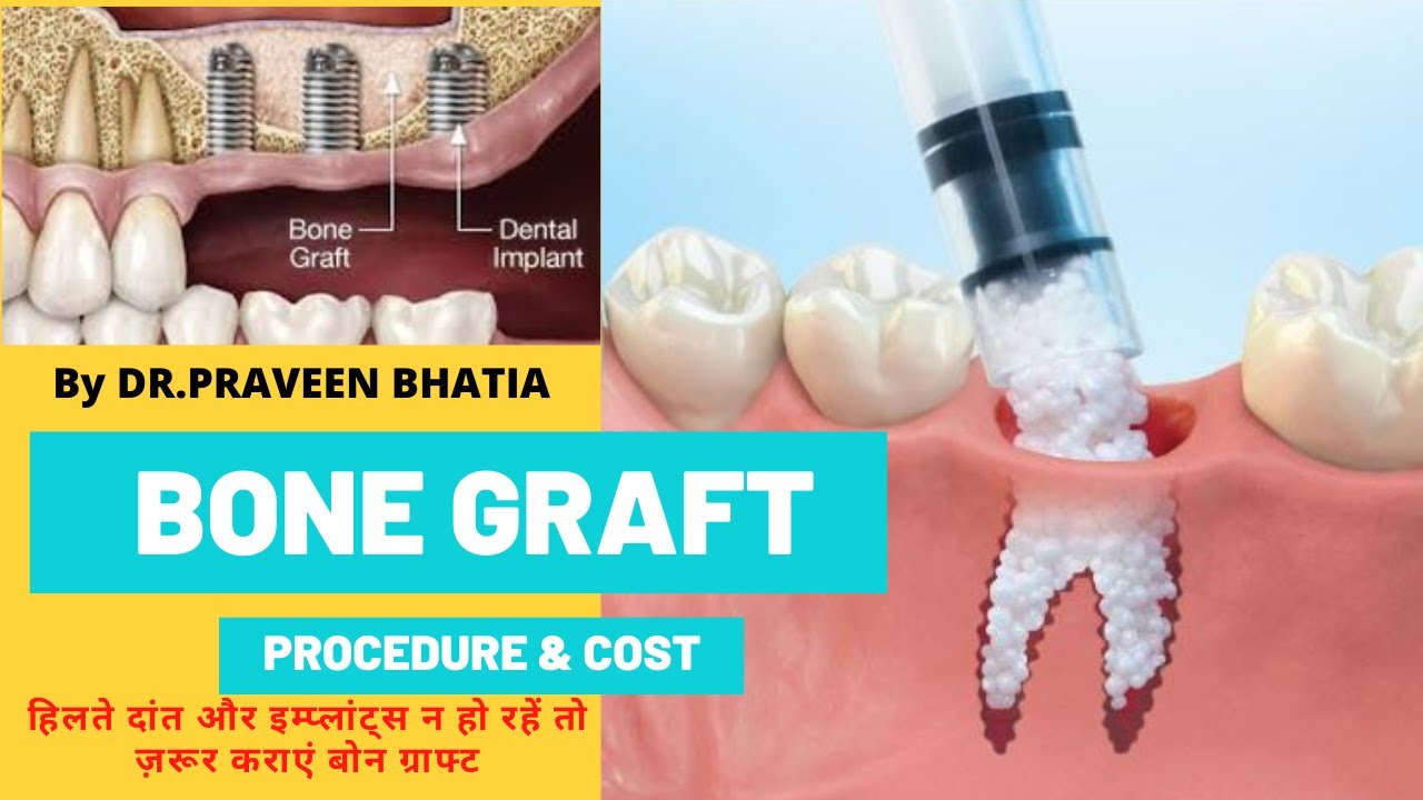 Need of BONE GRAFT ,its procedure & cost-किन स्तिथिओ में बोन  ग्राफ्ट की ज़रुरत पड़ती है,इसका खर्च-BDP