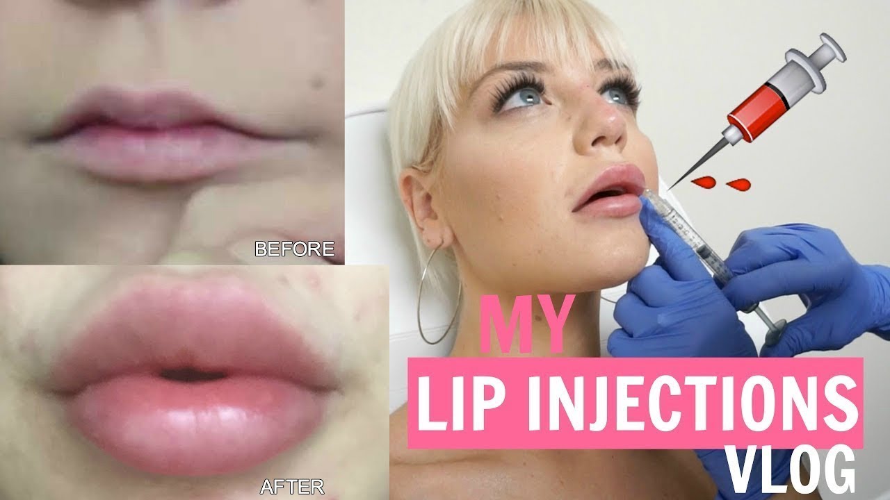 LIP INJECTIONS VLOG: TIPS & THINGS YOU SHOULD KNOW!