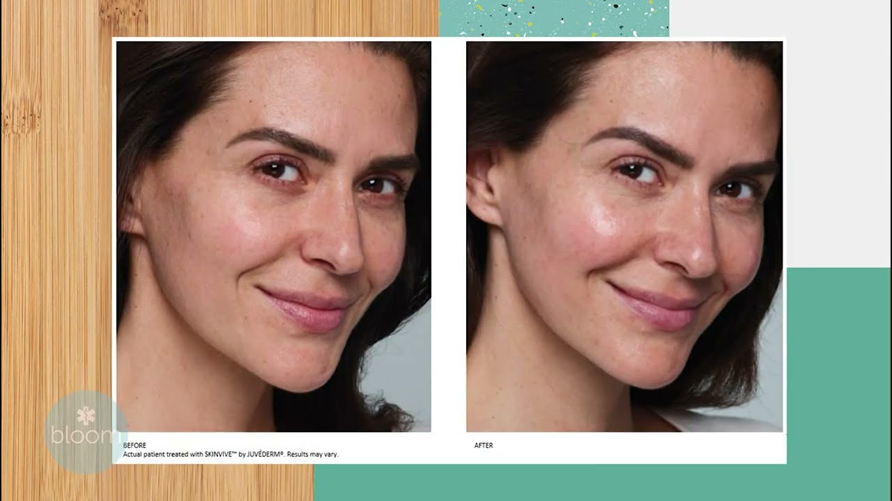 Skinvive: The New FDA Approved Treatment To Smooth Skin At Hermann Aesthetics