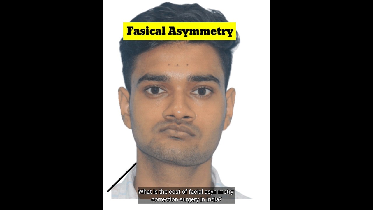 What is the cost of Facial Asymmetry Correction Surgery in India? | Condylar Hypoplasia