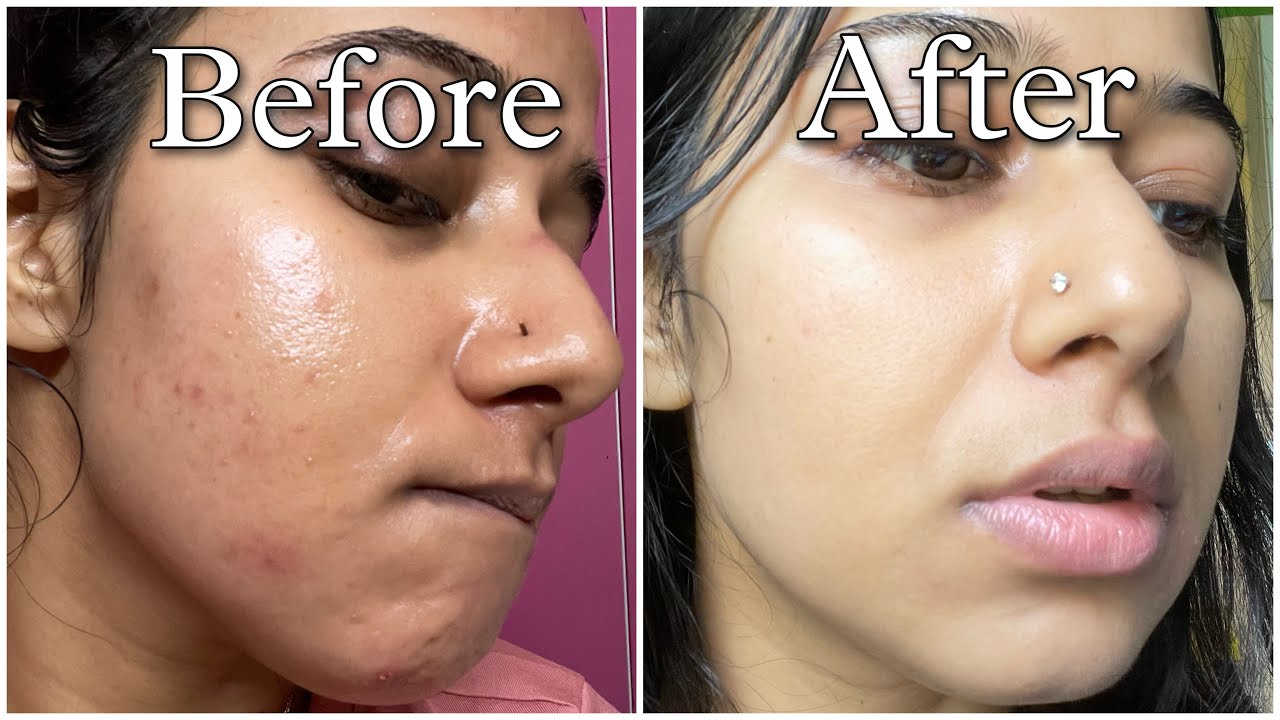 Clear Skin in 1 Minute #60secondrule | Best Face Wash Hack Ever