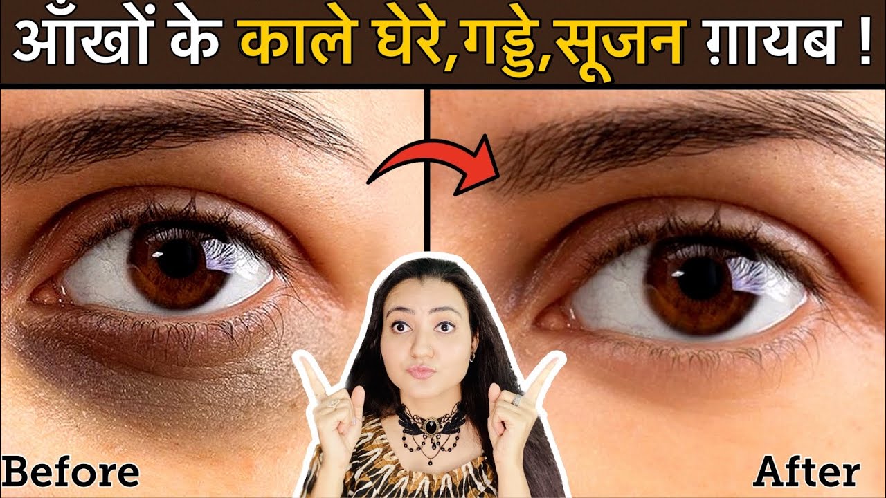 In 7 Days 💕 Remove DARK CIRCLES काले घेरे, PUFFY EYES, गड्ढे SUNKEN EYES Naturally | 100% Results
