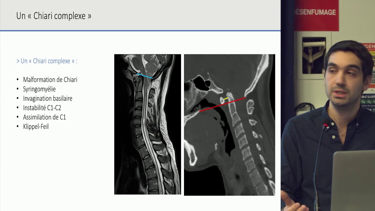 Malformations de la jonction craniocervicale - Dr Steven KNAFO