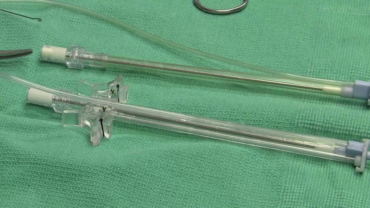 OTT: Video Tech Brief - Simplified Antegrade Cardioplegia Catheter