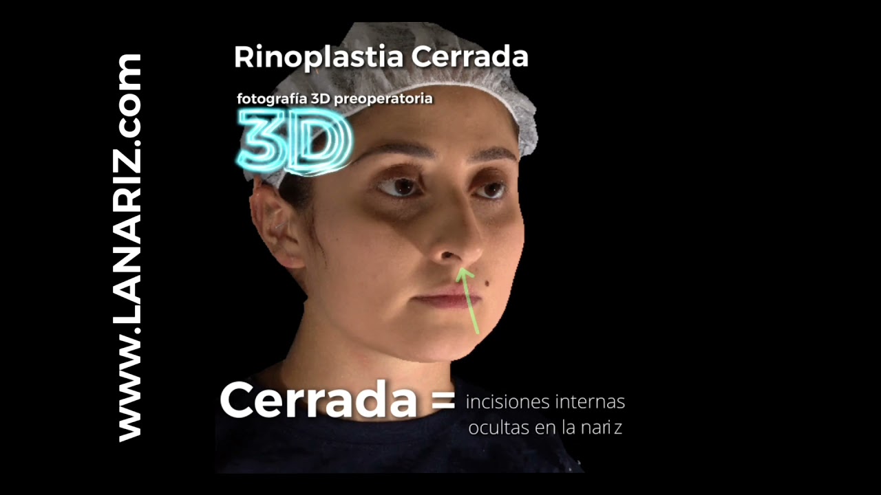 Rinoplastia cerrada natural & estructurada