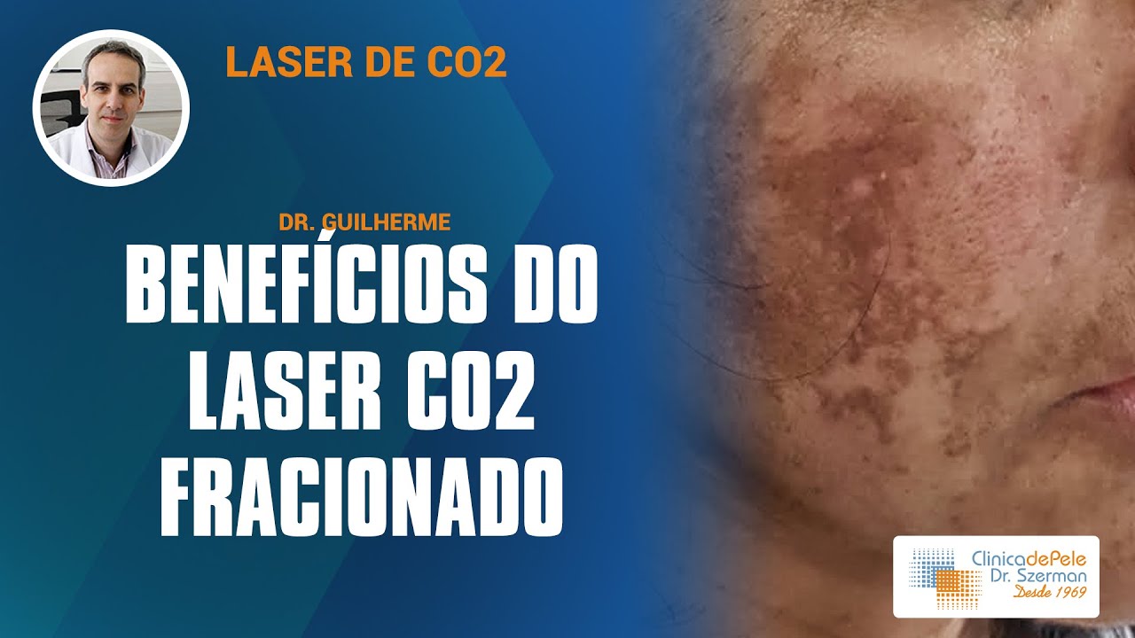 Laser CO2 Fracionado [Benefícios]