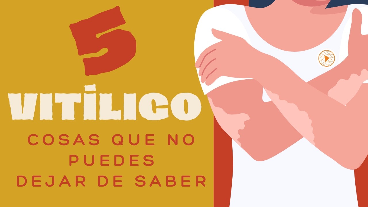 VITILIGO | Las 5 cosas que no puedes dejar de saber!
