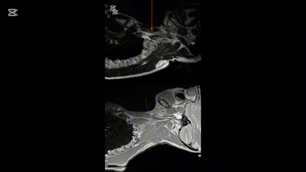 MRI Structural Changes – Documented Case | Professional Medical Review Requested