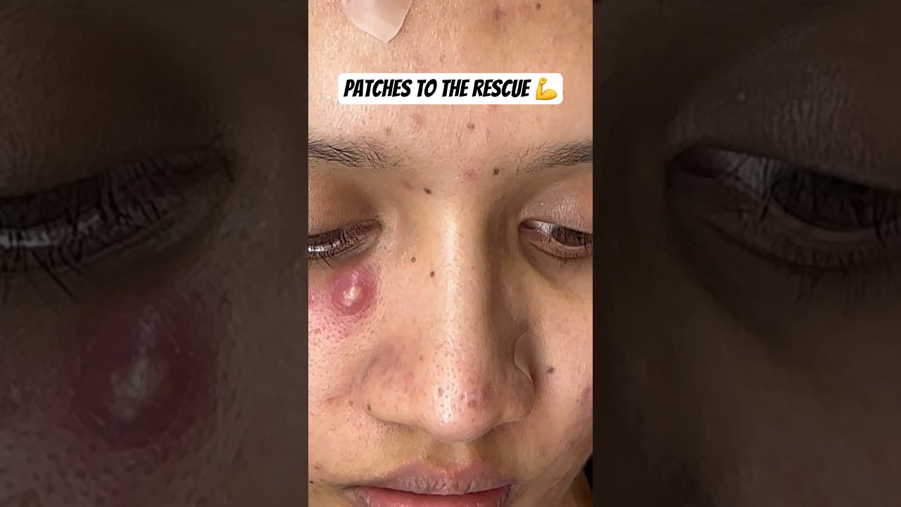 Patches to the rescue 💪 #acne #acnetreatment #cystic #cystpoping #acnepatch #pimplepatch #acnescars