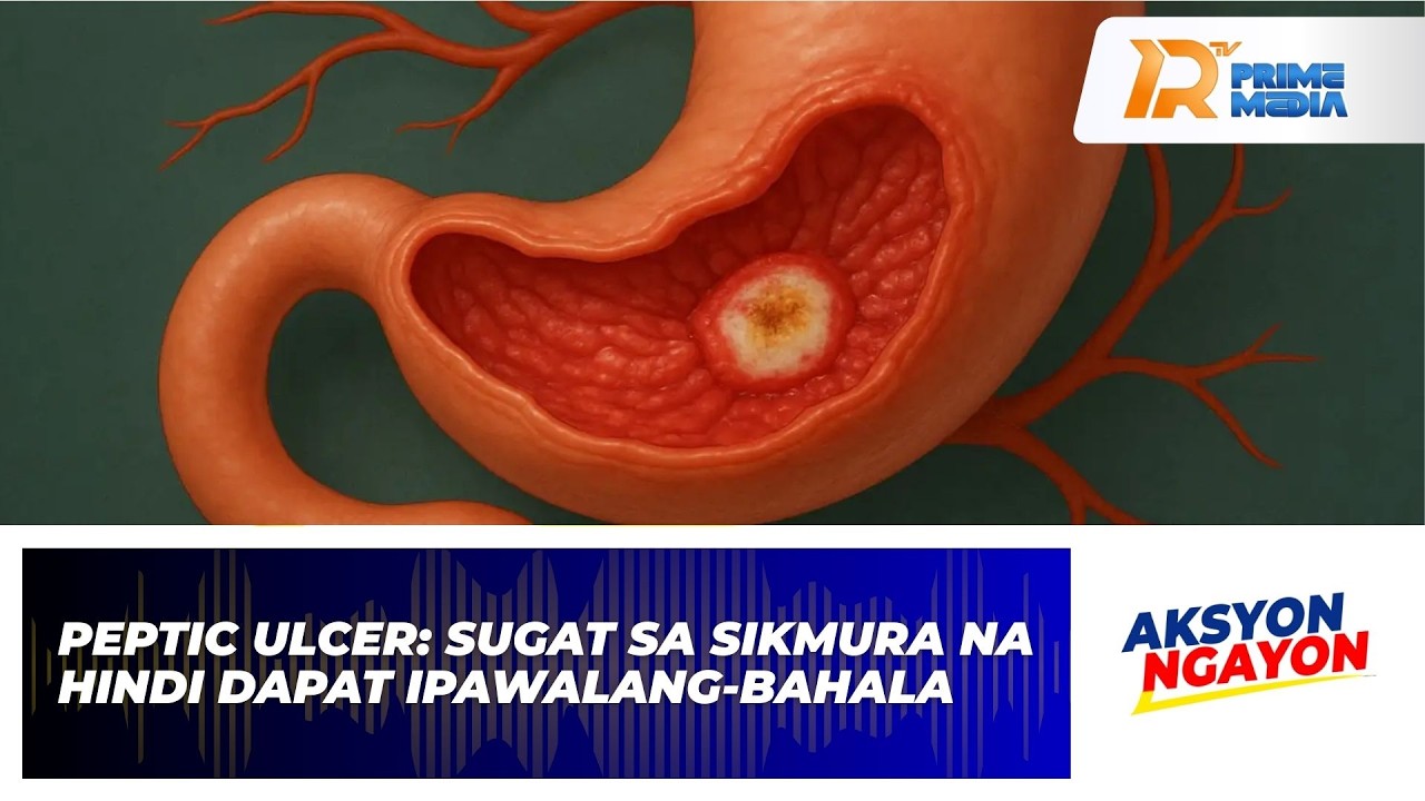 Peptic Ulcer: Sugat Sa Sikmura Na Hindi Dapat Ipawalang-Bahala | Aksyon Ngayon
