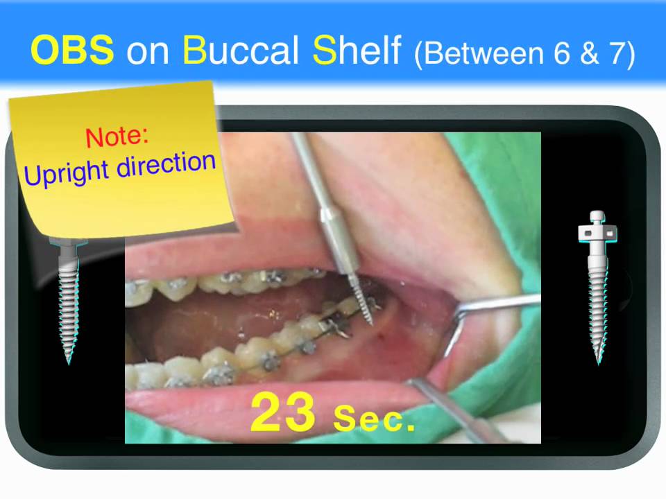 OBS-2. Buccal Shelf