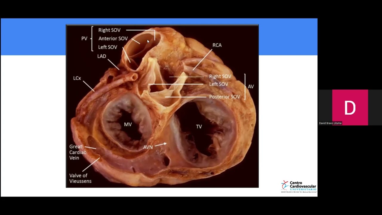 Seminario 16: Arritmias ventriculares en ausencia de cardiopatía