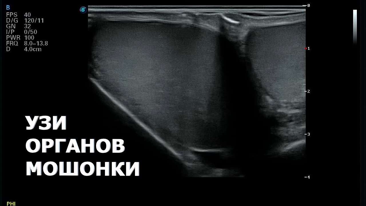 Алгоритм проведения УЗИ органов мошонки