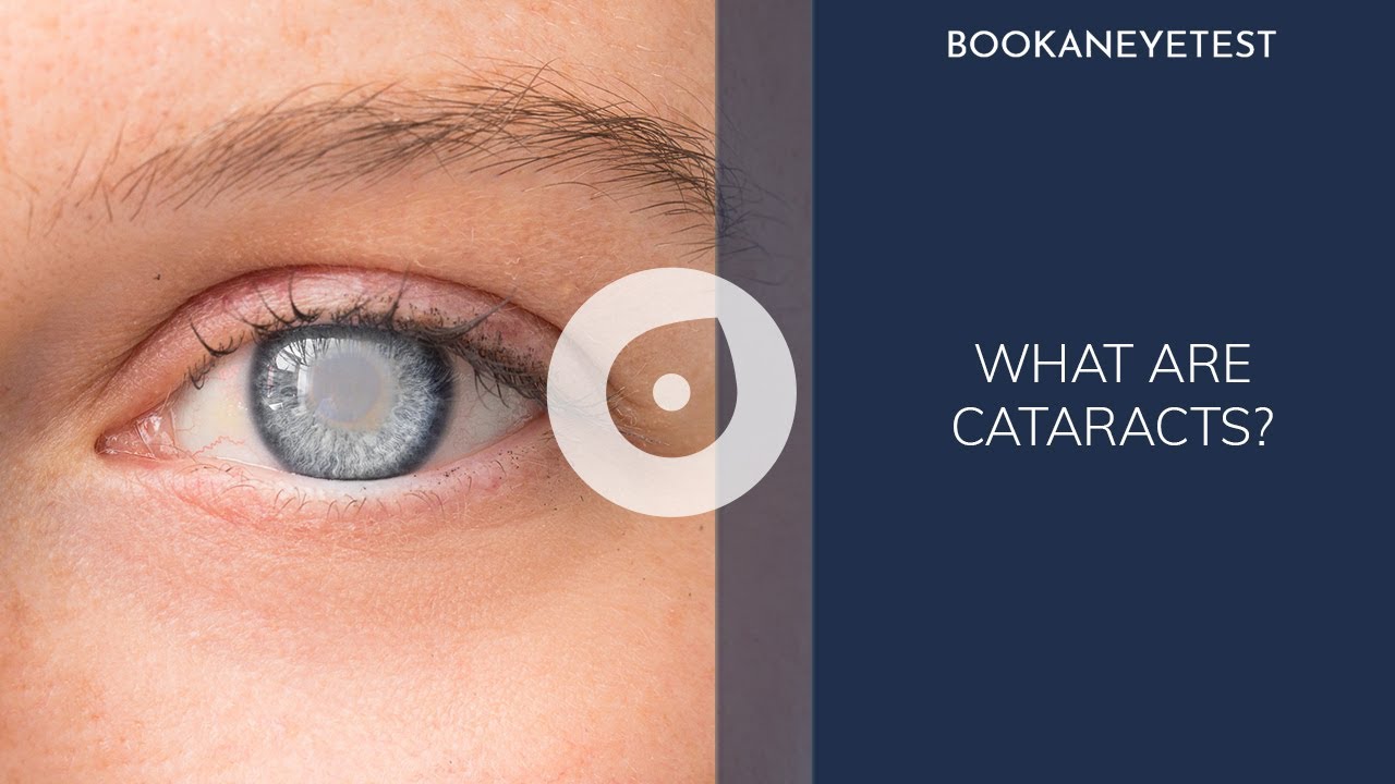 Cataracts | What are Cataracts? | Book an eye test | Doctor Explains Cataract Symptoms and Treatment