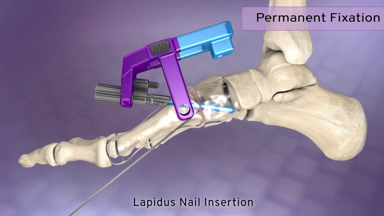 Phantom™ Small Bone Intramedullary Nail Lapidus Procedure