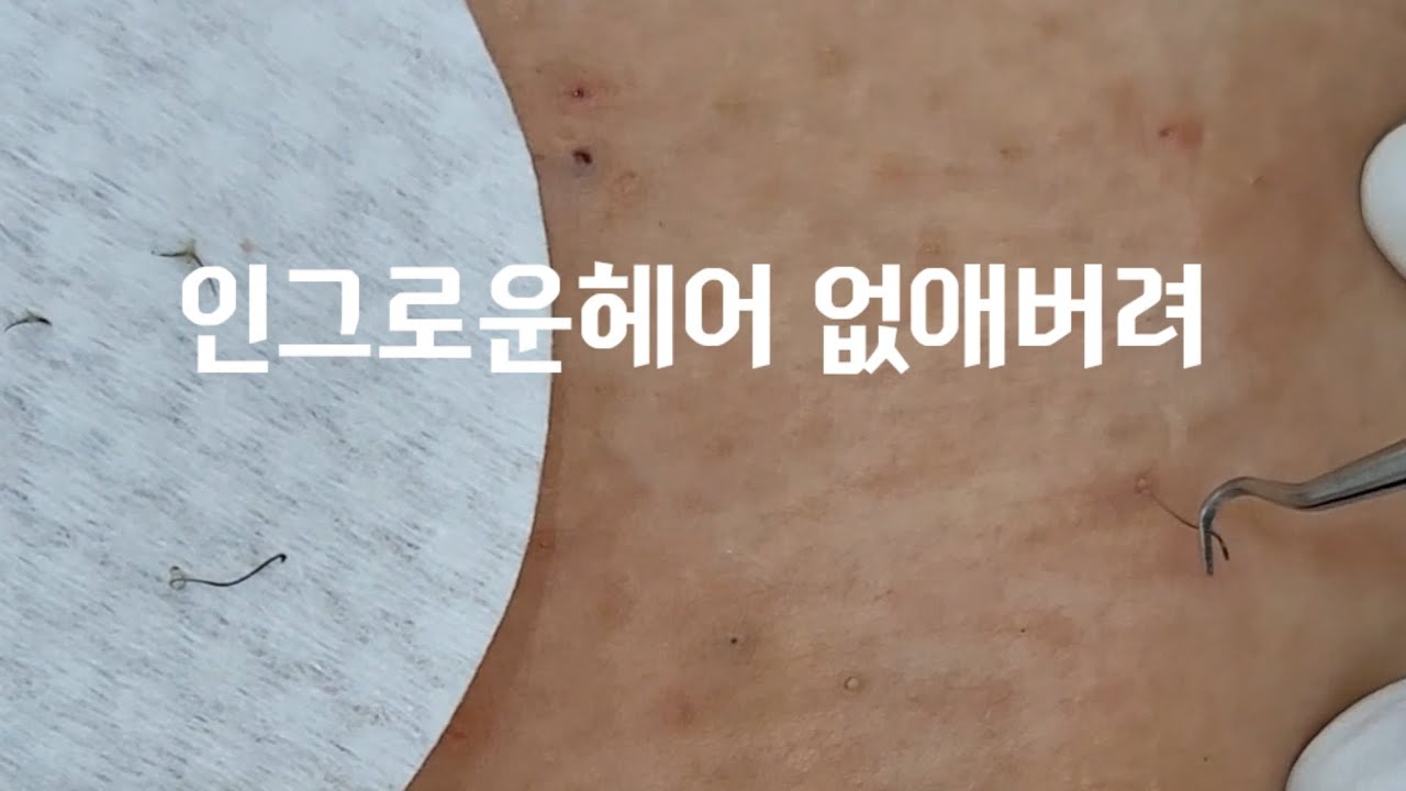 인그로운헤어 , 숨은털 뽑기
