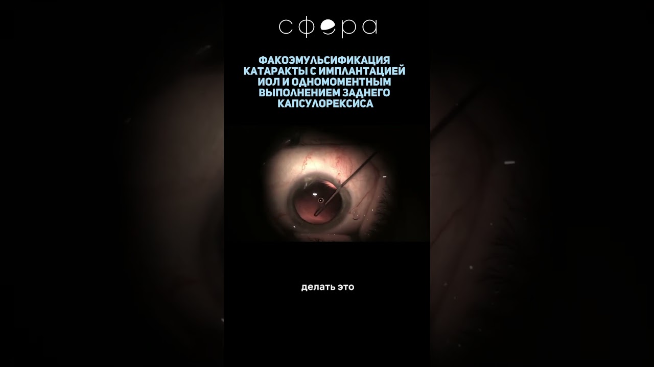 Факоэмульсификация катаракты с имплантацией ИОЛ и одномоментным выполнением заднего капсулорексиса