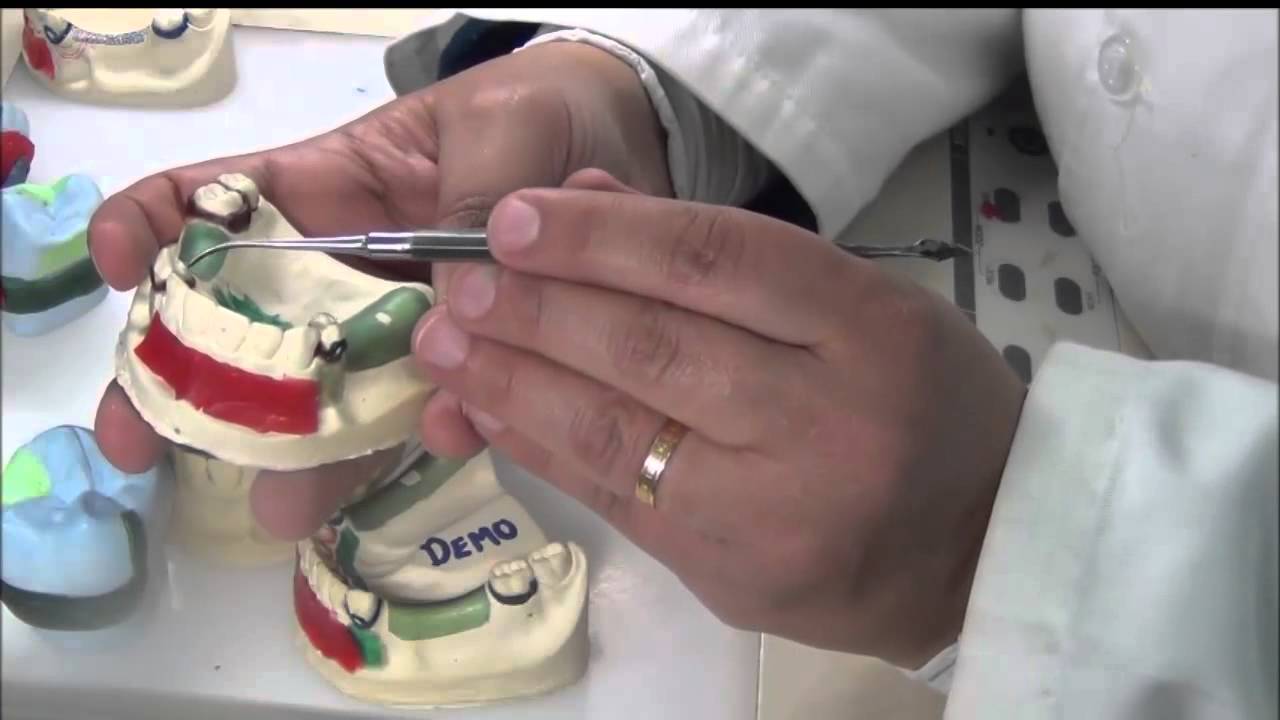 14 Permanent RPD: Secondary Cast Blockout and Duplication