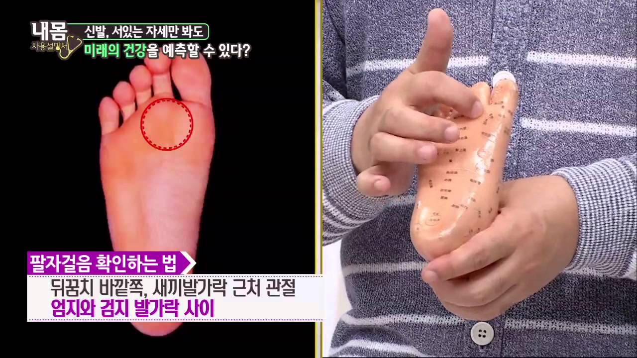 팔자 걸음 확인법, 심각성과 일어날수 있는 병들?! [내 몸 사용 설명서] 57회 20150704