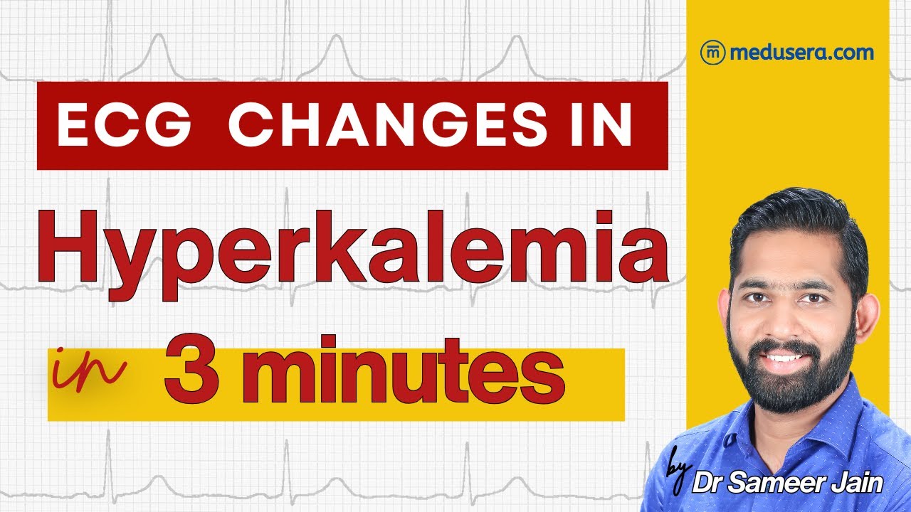 #hyperkalemia #ecg changes - peaked T wave, flat P wave, Prolonged PR interval & wide QRS complex