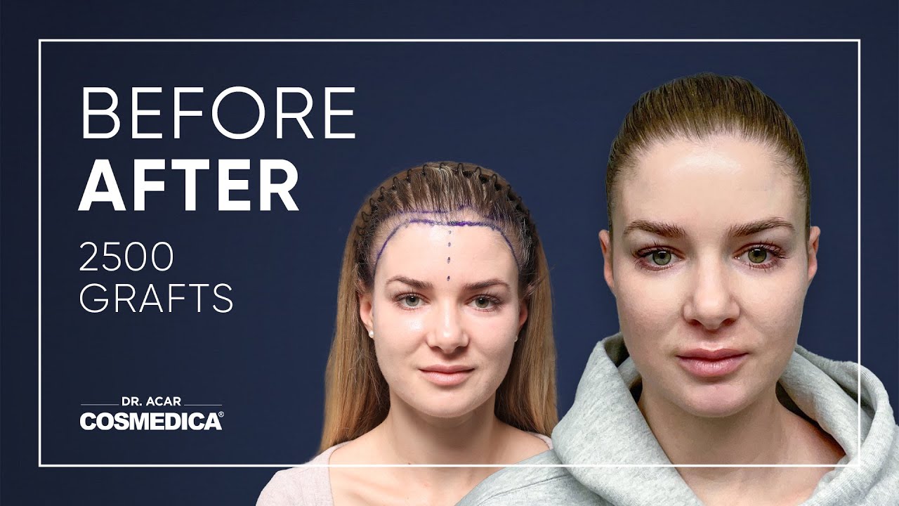 World’s best woman hair transplant result in Cosmedica Clinic by Dr. Acar | Cosmedica Clinic
